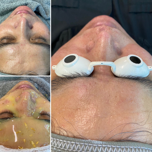 Dermaplane with calming chamomile gelly mask.