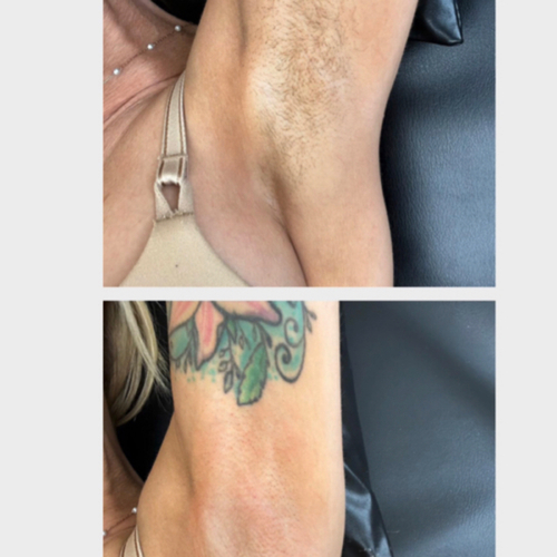 Before & After Underarm Wax