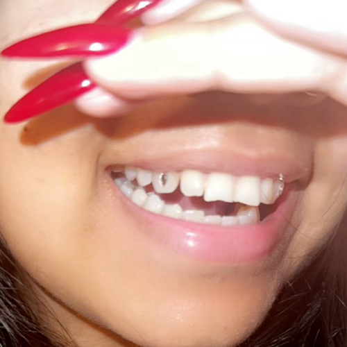 Tooth Gems Sparkle 