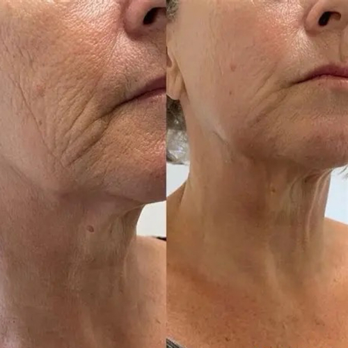 3 HIFU treatments 

