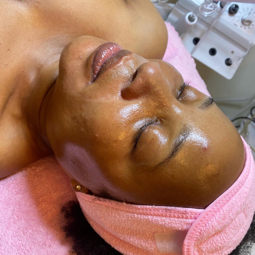 Results after a HydraPlane Facial
