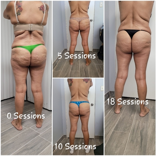 Best Cellulite Treatment in Toronto by massagebydmitri on DeviantArt