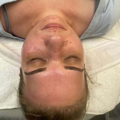 Post Microneedle