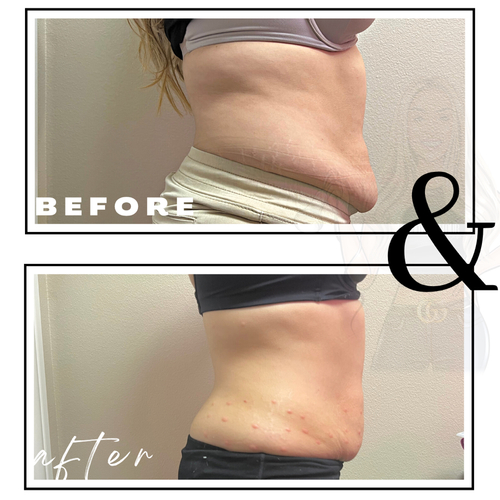 Lipo Shots - 2 Sessions 