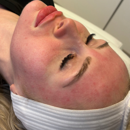 Genius RF Microneedling & Lase MD