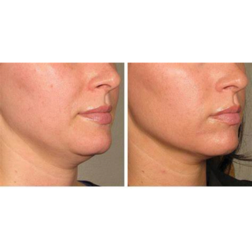 RF Skin Tightening focused on under chin and jawline tightening 