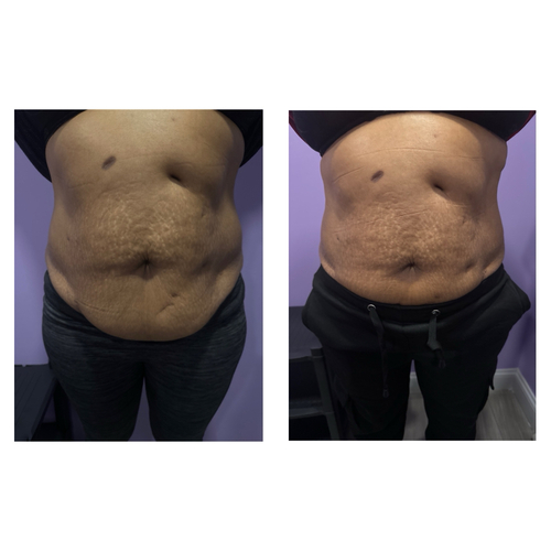 10 Lipo with cavitation on stomach 