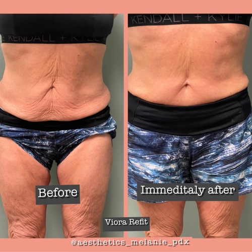 1 treatment of VIORA REFIT 
1/21/22