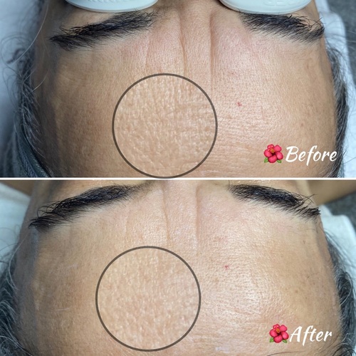 Increased hydration, improved texture, reduction of lines and depth of wrinkles. Hawaiian Islands facial with gua sha.