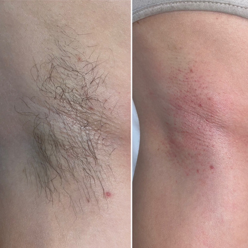 Before and after underarm waxing 