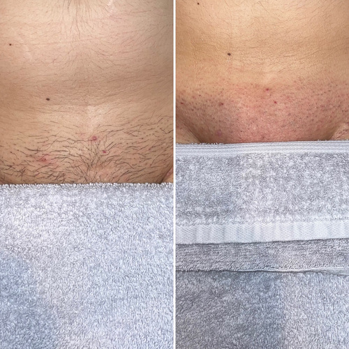 Before and after Brazilian wax 