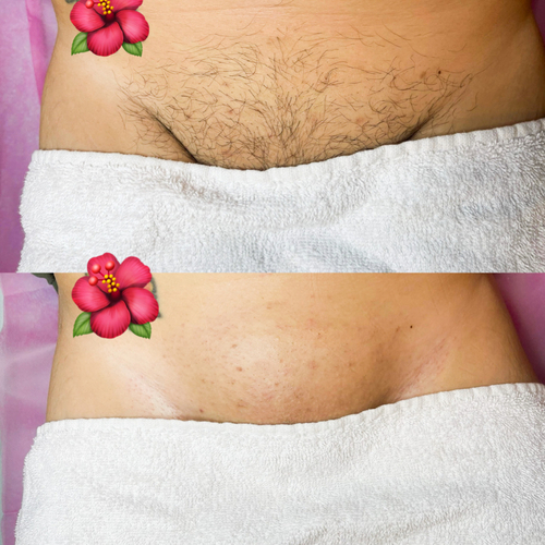 Brazilian Wax Before and After