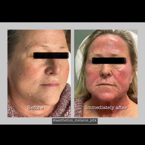 V-FR Fractional resurfacing 1 treatment 