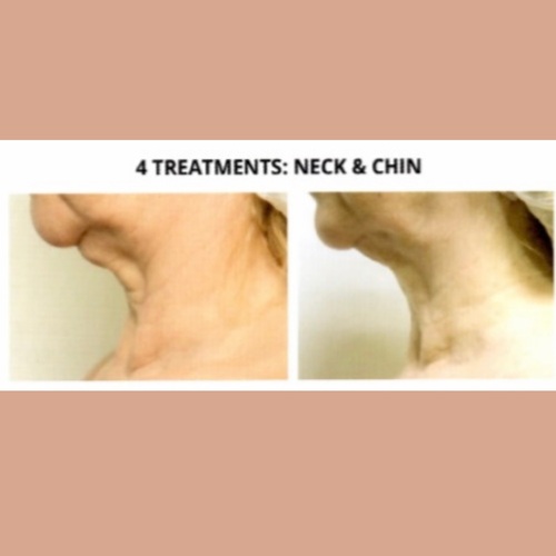 4 treatments Skin Tightening on neck