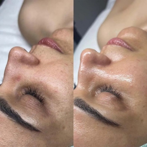 Facial
