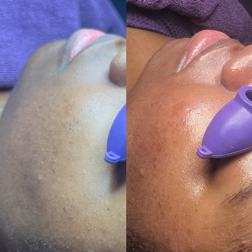 Before & After of one session of The Deep Clean 