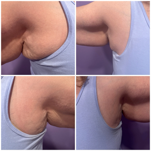 5 treatments of laser Lipo cavitation . 