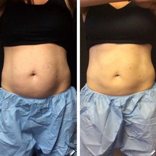 Lipo Cavitation results after 8 Treatments 