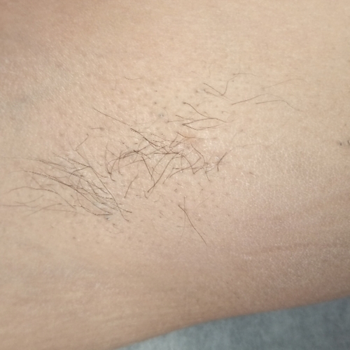 Underarm 