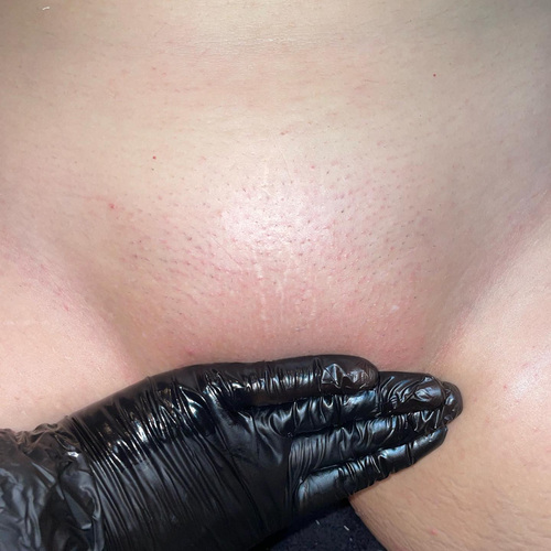 After Brazilian Wax 