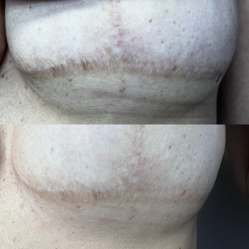 One session of Inkless Scar Revision, healed 10 weeks