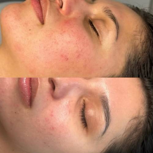 Struggling with rosacea? Check out this amazing transformation! We focused on reducing redness and flare-ups with a customized treatment plan. So proud of this client’s progress!