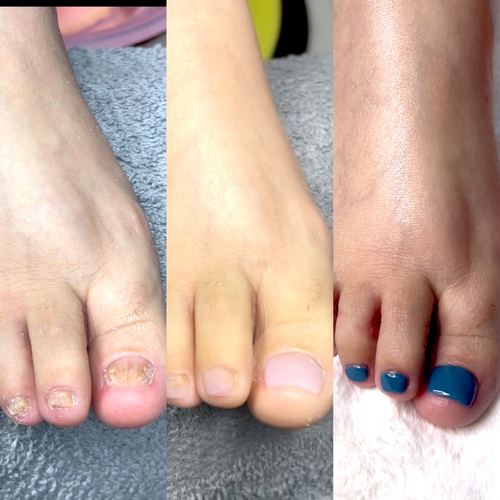 Toenail restoration 