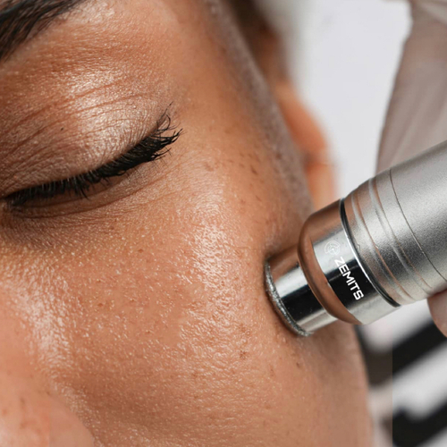 Microdermabrasion