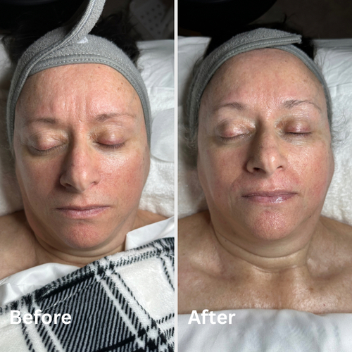 Custom dehydrated skin to help reduce redness, fine lines and wrinkles 