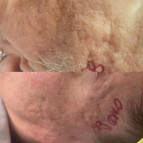 Dermaplane Facial to Remove dead skin and fine hairs
