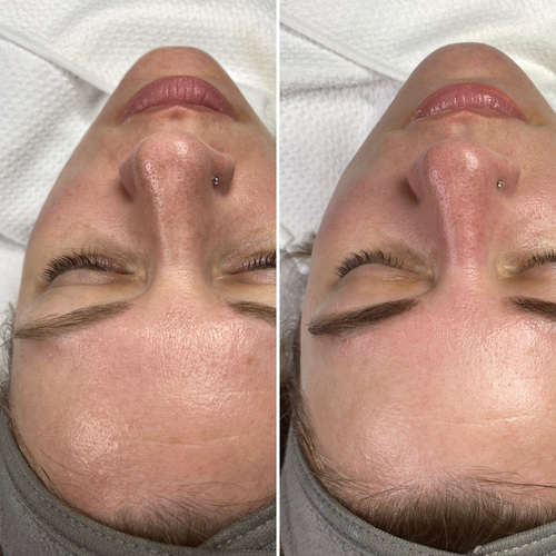 Before and after dermaplane with wax and tint: Hydrated glowing skin and brows to enhance her eyes .
