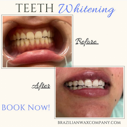 Pearly Whites In Just 1 Hour! 
