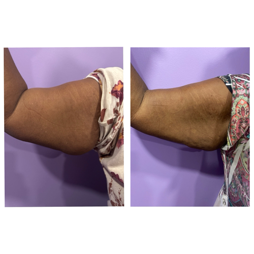 5 skin tightening treatments on arms 
