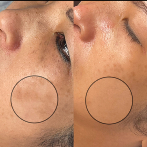 Mandelic Chemical Peel 