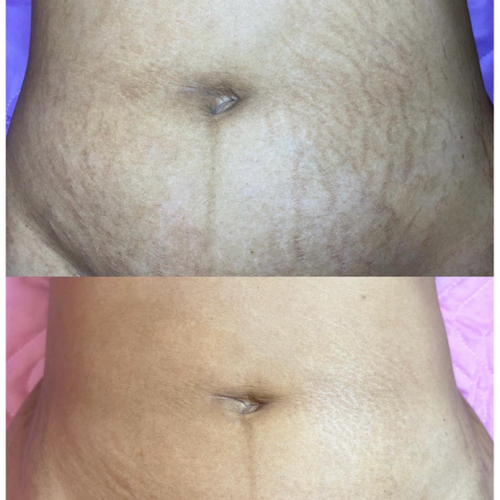 Horizontal Abdominoplasty Line Blending