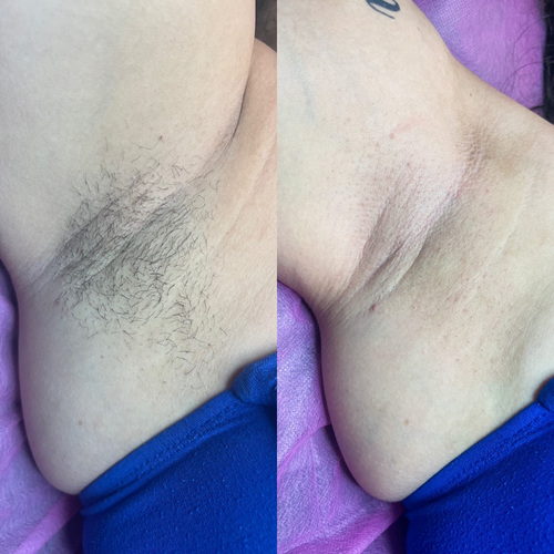 Underarm Wax before and after 
