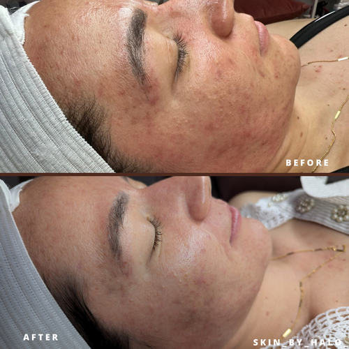 Acne Treatment. Requires Acne Consultation.