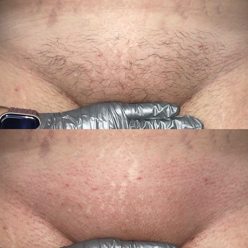 Before and after Brazilian wax (6 weeks in between) 