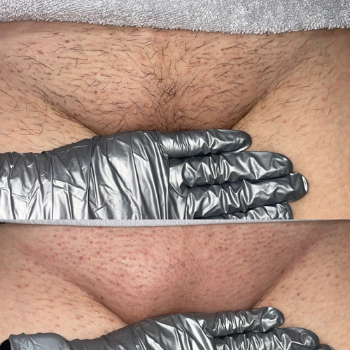 Before and after Brazilian waxing 