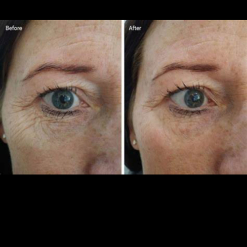 Skin Tightening on eye area
