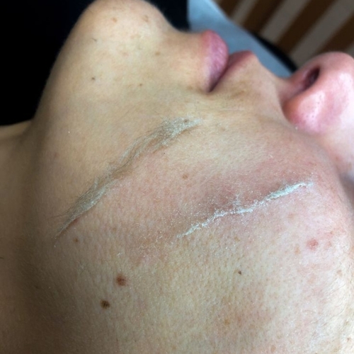 Dermaplaning 