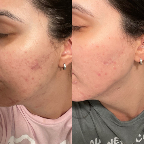Incredible results after a chemical peel session! We’ve worked hard to reduce acne breakouts and now focusing on tackling hyperpigmentation. 