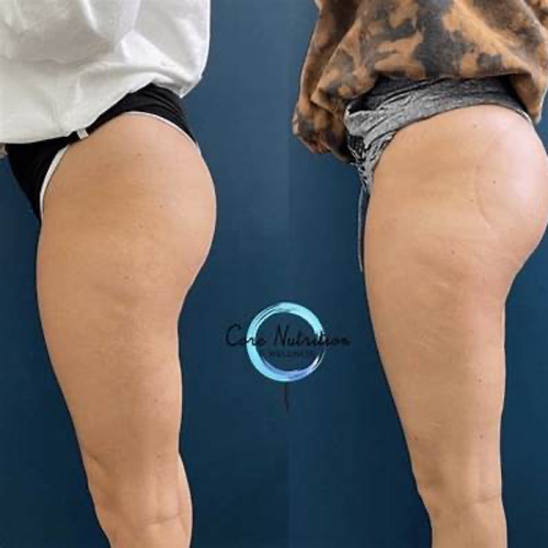 4 Treatments of Non-invasive Butt Cupping 