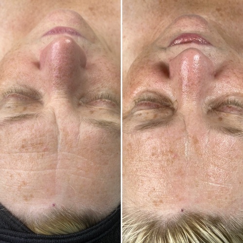 Before and after Oxygen Rx treatment with cocoa enzyme.