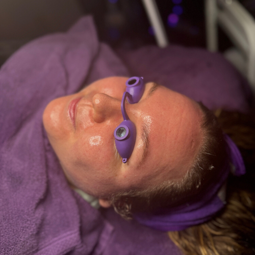 Advanced chemical peel to improve skin texture and clear pores 