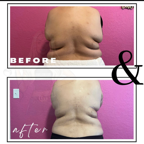 Get Snatched - Back & Sides plus Lipo Shots - 2 Sessions