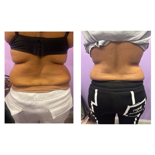 10 Lipo on back with cavitation treatments 