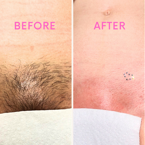 Brazilian With Vajazzle