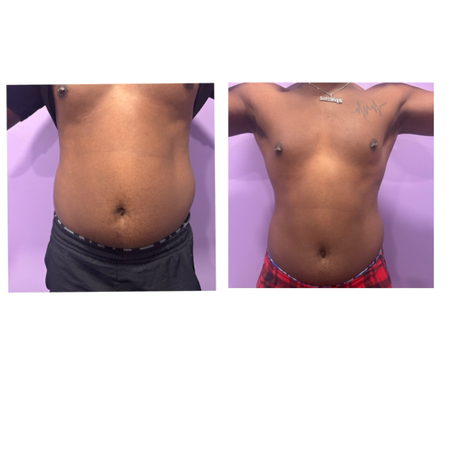 5 treatments of Lipo Cavitation to burn stomach and love handles 