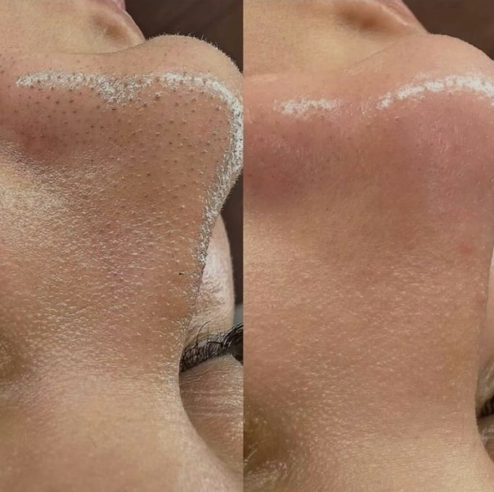 Deep Cleansing Facial at SiempreBellasBeautySpa in North Miami, FL